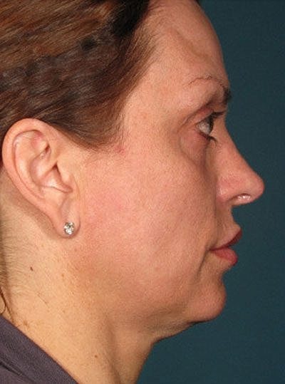 Cheek Fillerzz Before & After