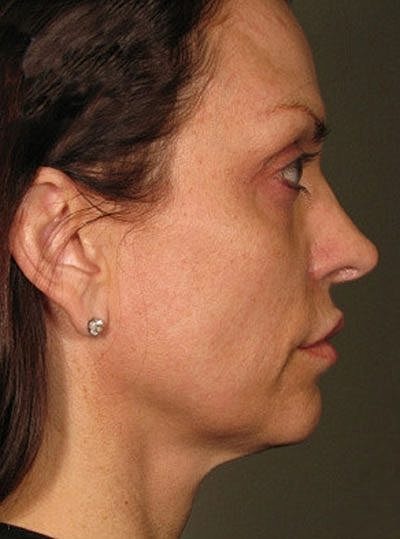 Cheek Fillerzz Before & After