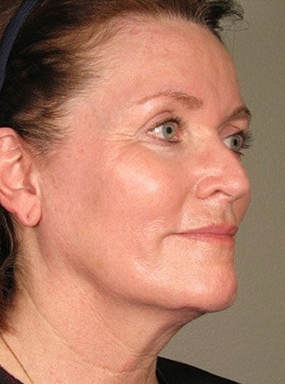 Cheek Fillerzz Before & After