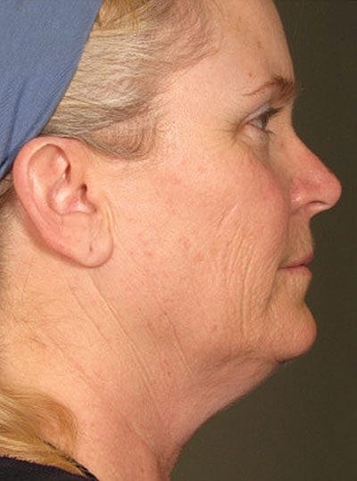 Cheek Fillerzz Before & After