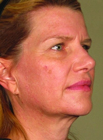 Cheek Fillerzz Before & After