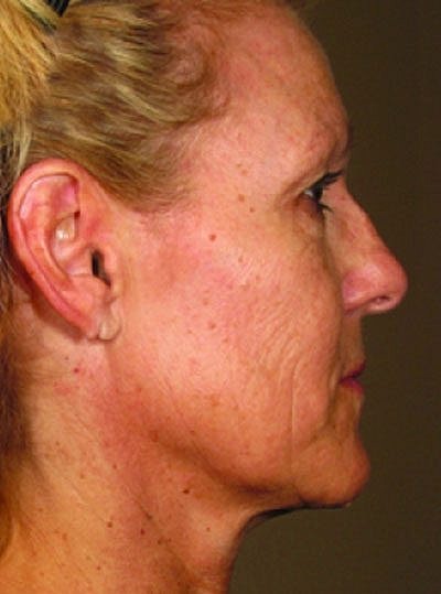 Cheek Fillerzz Before & After