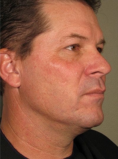 Cheek Fillerzz Before & After