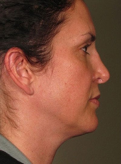 Cheek Fillerzz Before & After