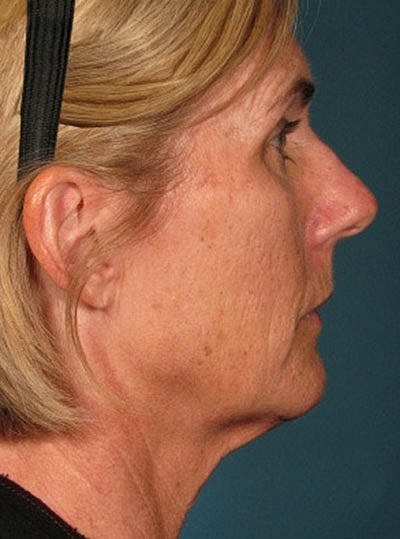 Cheek Fillerzz Before & After