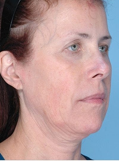 Cheek Fillerzz Before & After