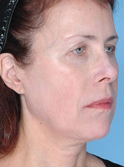 Cheek Fillerzz Before & After