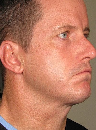 Cheek Fillerzz Before & After