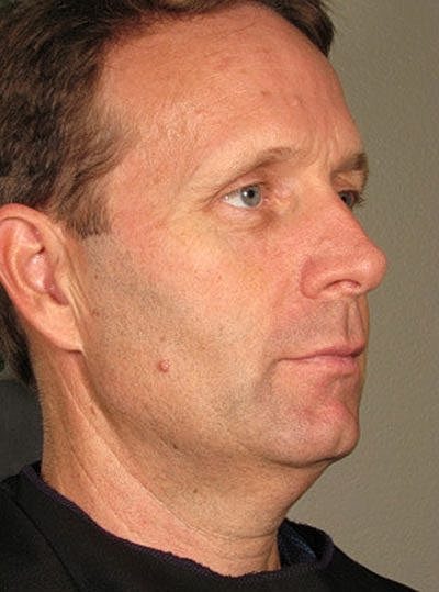 Cheek Fillerzz Before & After