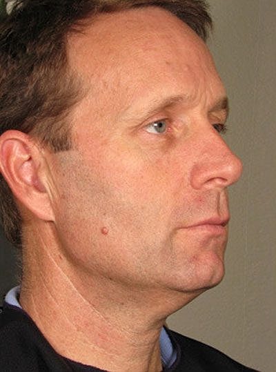 Cheek Fillerzz Before & After