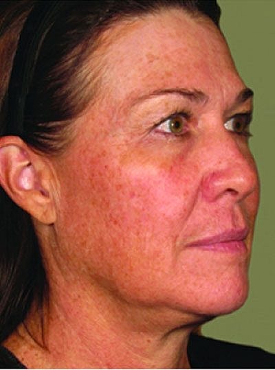 Cheek Fillerzz Before & After