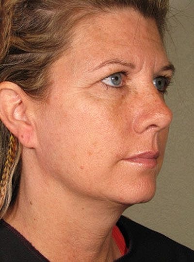 Cheek Fillerzz Before & After