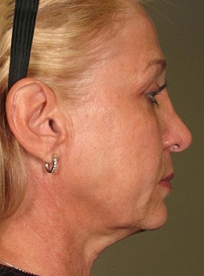 Cheek Fillerzz Before & After