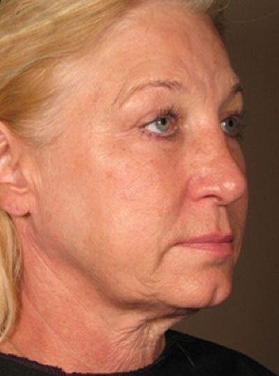 Cheek Fillerzz Before & After