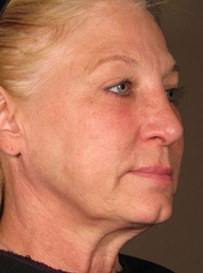 Cheek Fillerzz Before & After