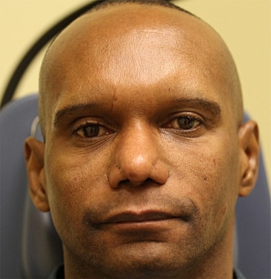 Cheek Fillerzz Before & After