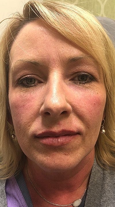 Cheek Fillerzz Before & After