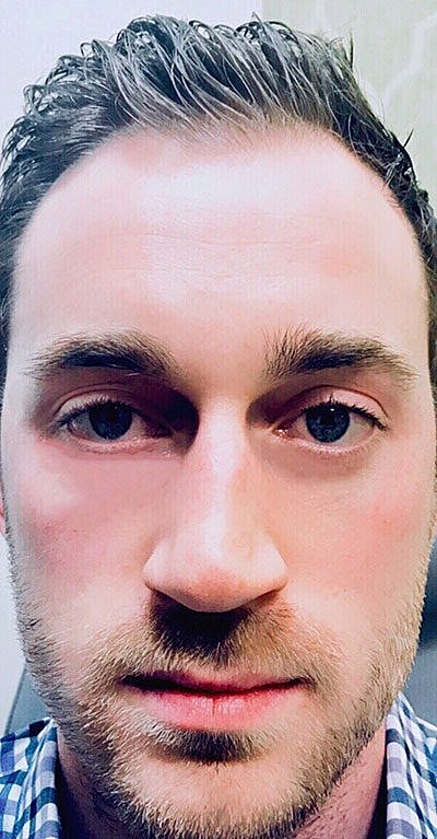 Cheek Fillerzz Before & After