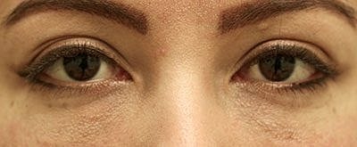 Cheek Fillerzz Before & After