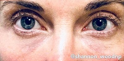 Cheek Fillerzz Before & After