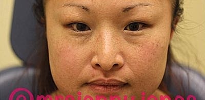 Cheek Fillerzz Before & After