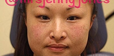 Cheek Fillerzz Before & After