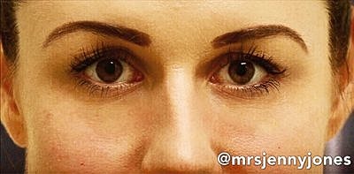 Cheek Fillerzz Before & After