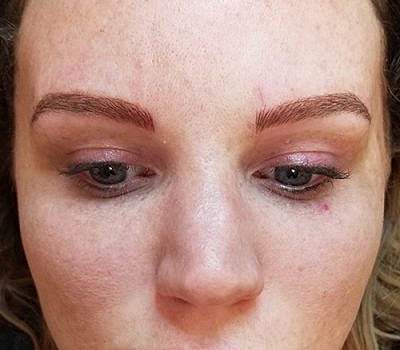 Cheek Fillerzz Before & After