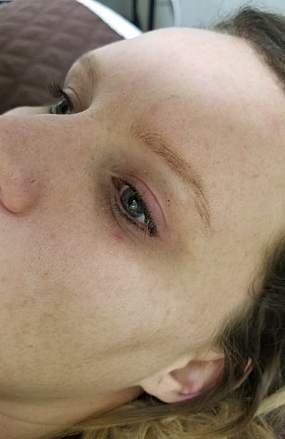 Cheek Fillerzz Before & After