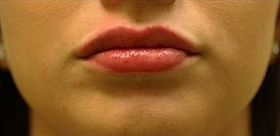 Cheek Fillerzz Before & After