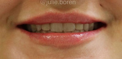 Cheek Fillerzz Before & After