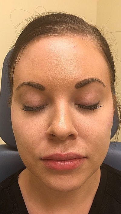 Cheek Fillerzz Before & After