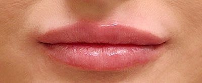 Cheek Fillerzz Before & After