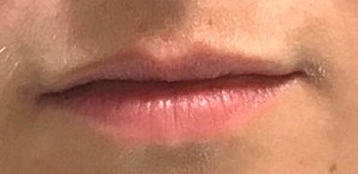 Cheek Fillerzz Before & After