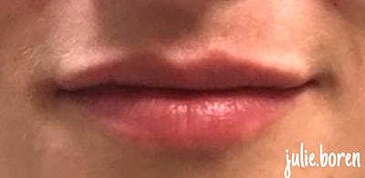 Cheek Fillerzz Before & After