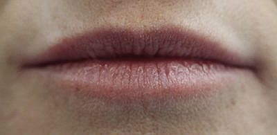 Cheek Fillerzz Before & After