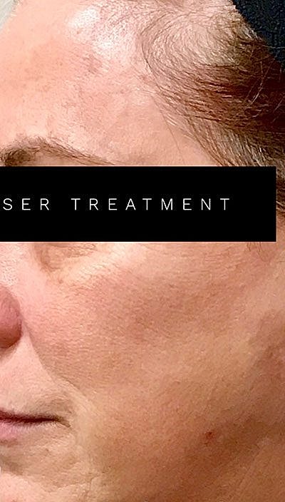 Cheek Fillerzz Before & After