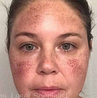 Cheek Fillerzz Before & After