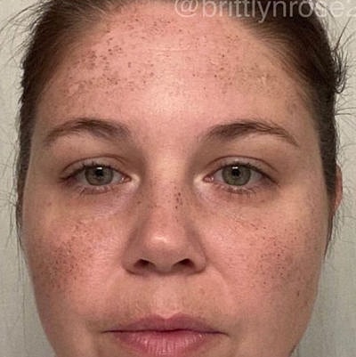 Cheek Fillerzz Before & After