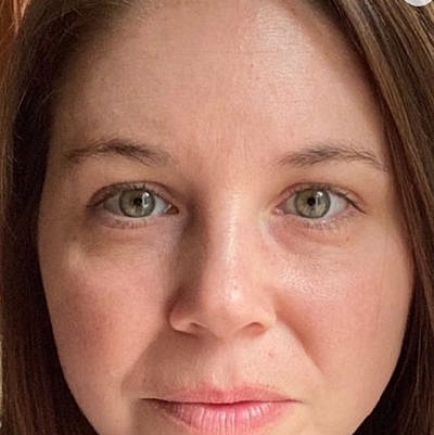 Cheek Fillerzz Before & After