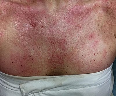 Cheek Fillerzz Before & After