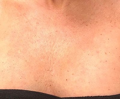 Cheek Fillerzz Before & After