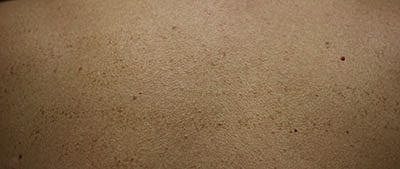 Cheek Fillerzz Before & After