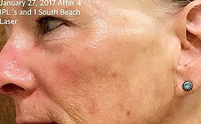 Cheek Fillerzz Before & After