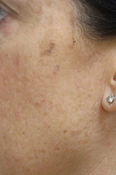 Cheek Fillerzz Before & After