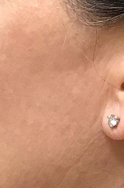 Cheek Fillerzz Before & After