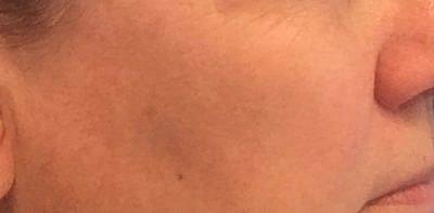 Cheek Fillerzz Before & After