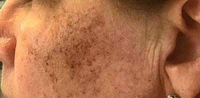 Cheek Fillerzz Before & After