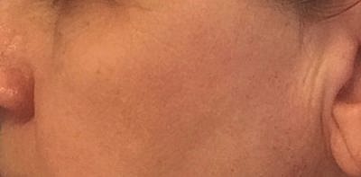 Cheek Fillerzz Before & After