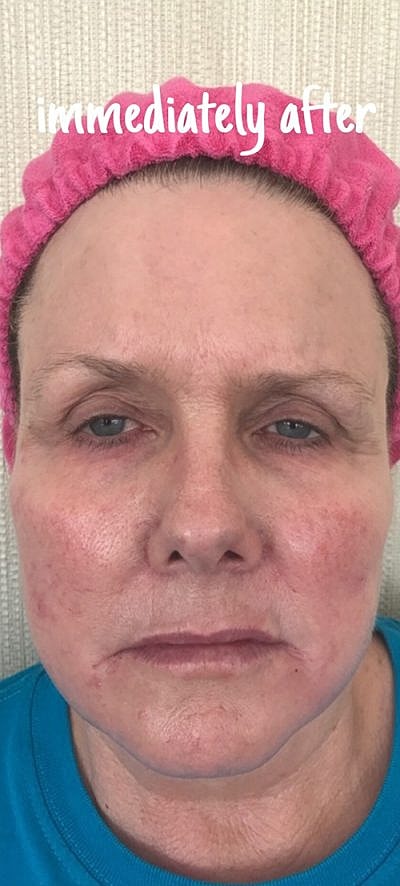 Cheek Fillerzz Before & After